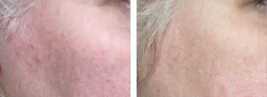 Rode wang voor en na 7 weken Skin Moisture IQ