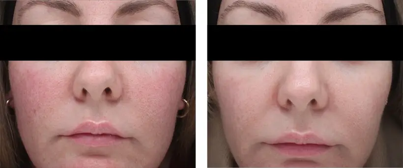 Rode wangen in week 1 en week 8 met Skin Clear Biome
