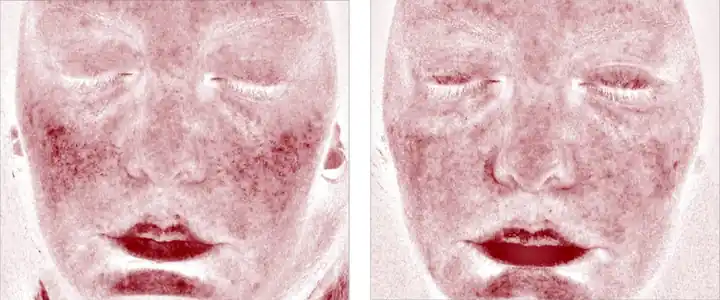 Roodheidsscan in week 1 en week 8 met Skin Clear Biome